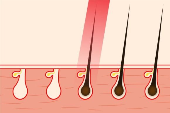 Download Hair Removal with Laser Light Vector - Vector Collection